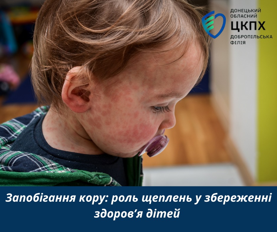 Запобігання кору: роль щеплень у збереженні здоров’я дітей