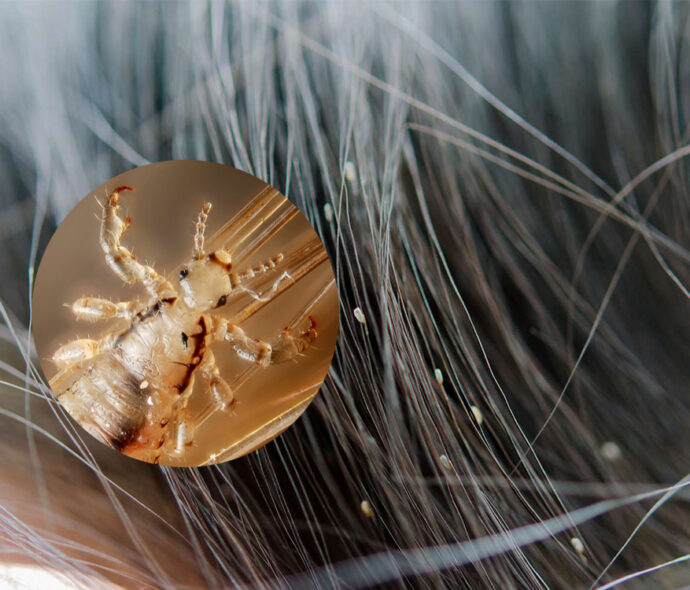 Педикульоз: маленькі паразити — велика проблема