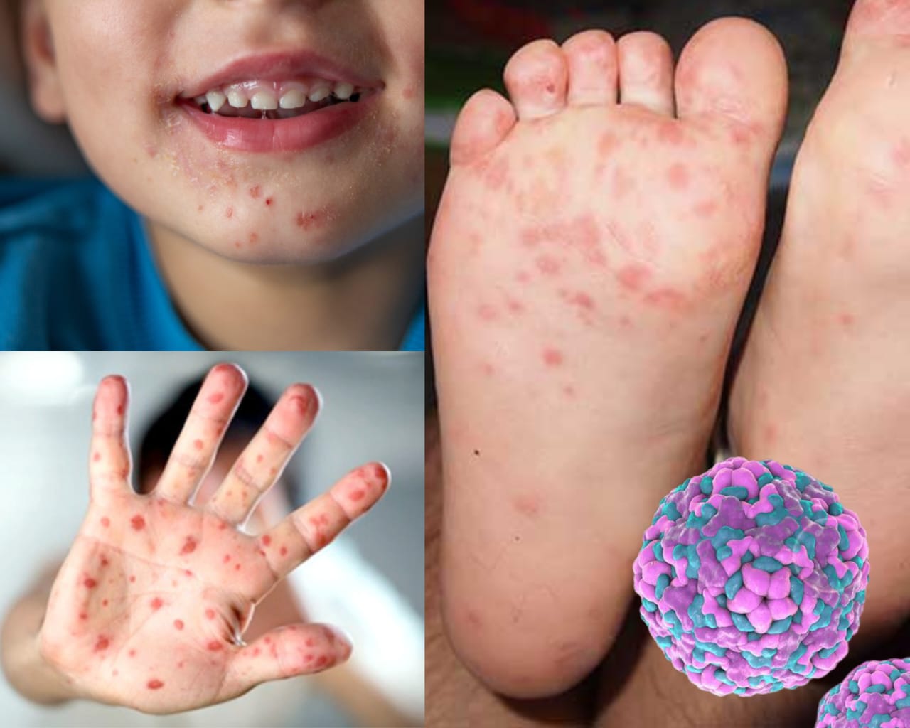 Вірус Коксакі: що це, як передається і як захиститися?