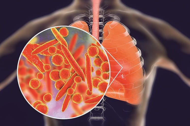 Всесвітній день боротьби з пневмонією: важливість обізнаності та профілактики